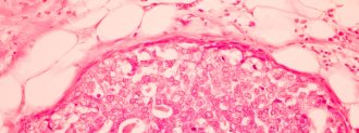 Breast Cancer Treatment