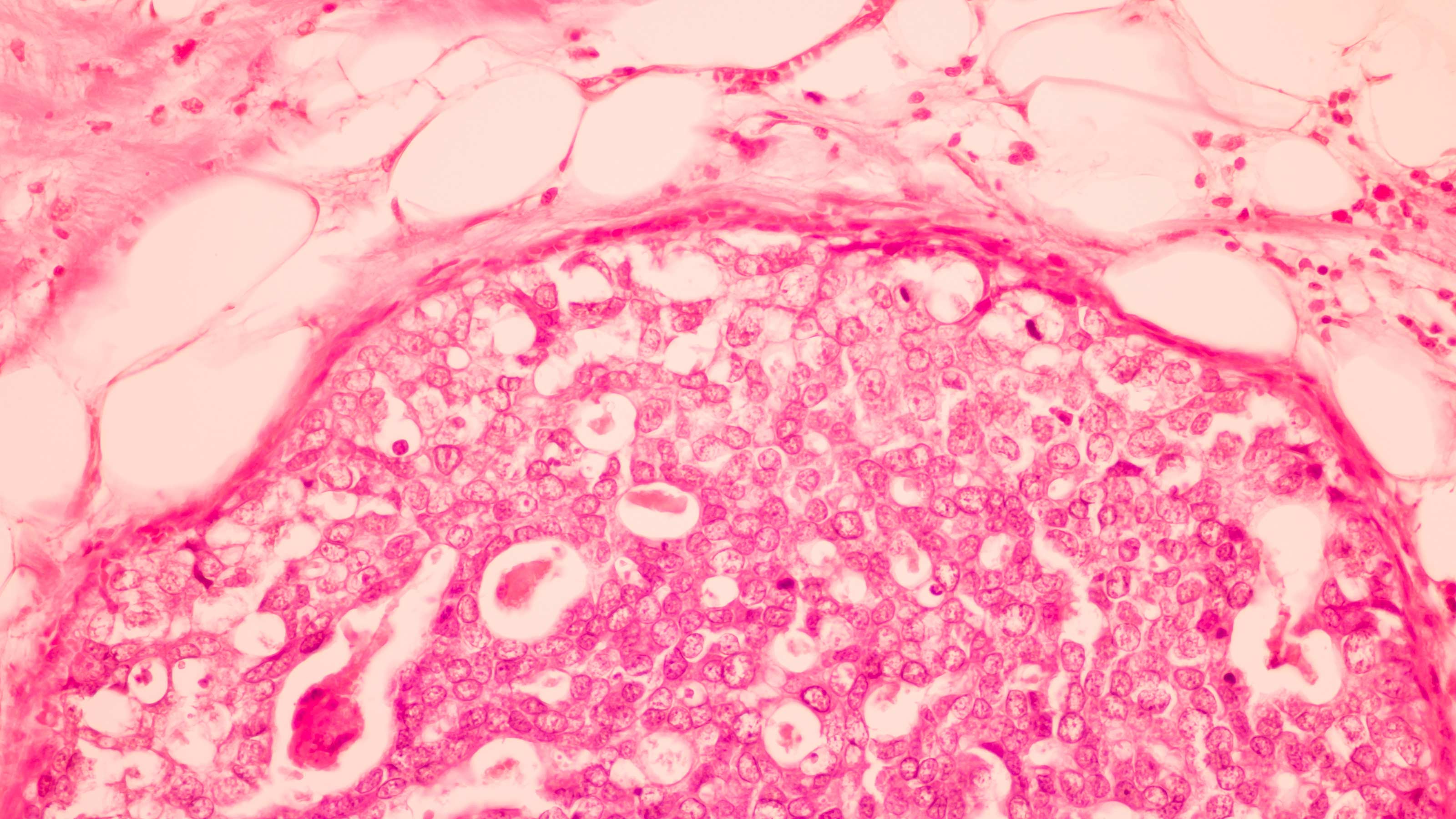 Breast Cancer Treatment