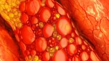 COVID-19 blood clots