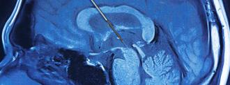 deep brain stimulation