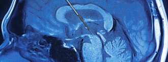 deep brain stimulation