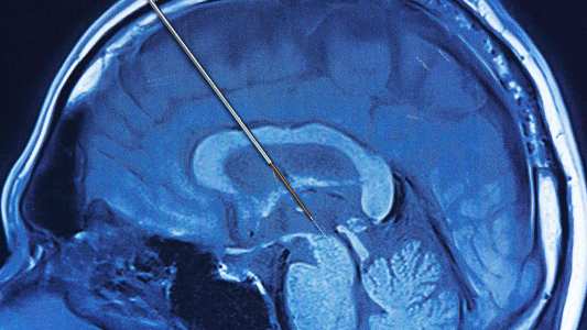 deep brain stimulation