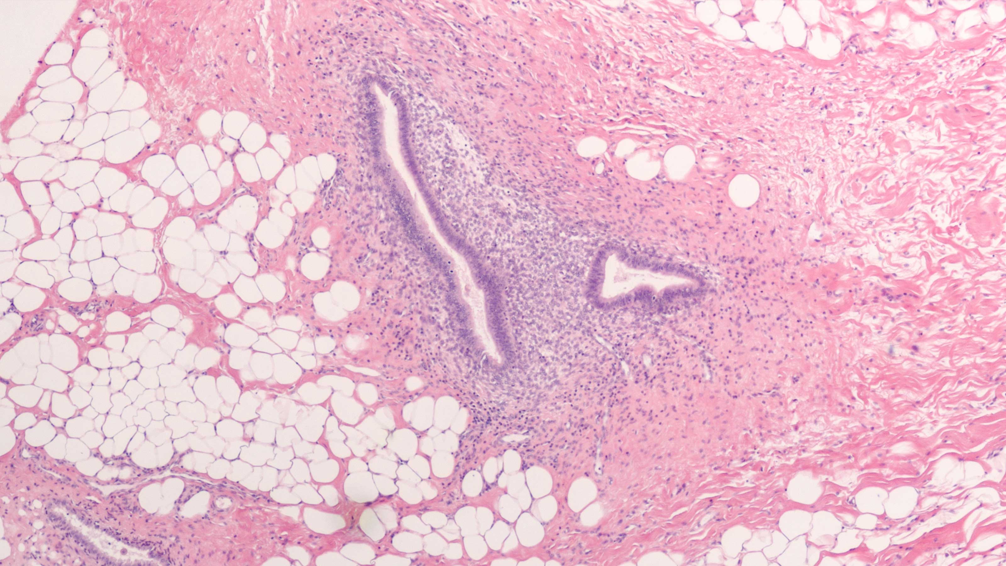 Endometriosis Treatment