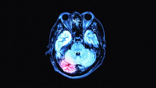 Coronavirus Affects the Brain