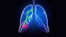 lung biopsy