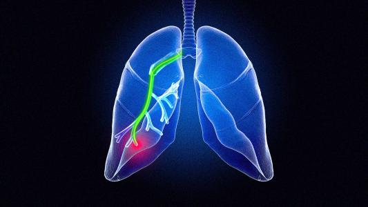 lung biopsy