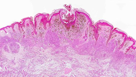 Malignant Melanoma