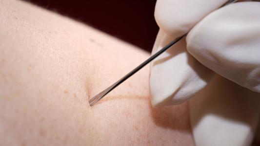 scarification vaccination