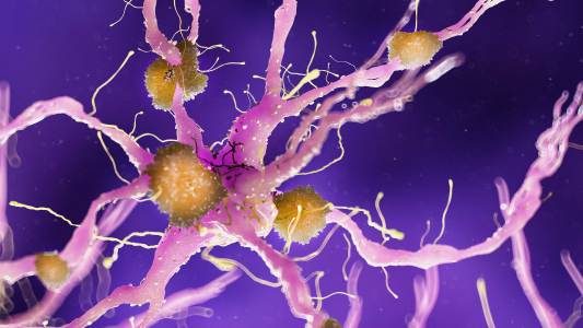 Test for Alzheimer’s