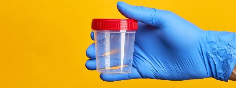 urine test for brain cancer