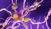 amyloid