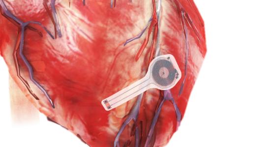 pacemaker