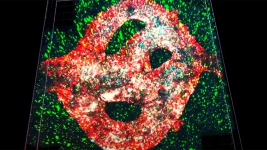 glioblastoma