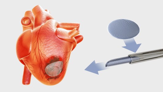 cardiac patch