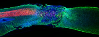 spinal cord injuries