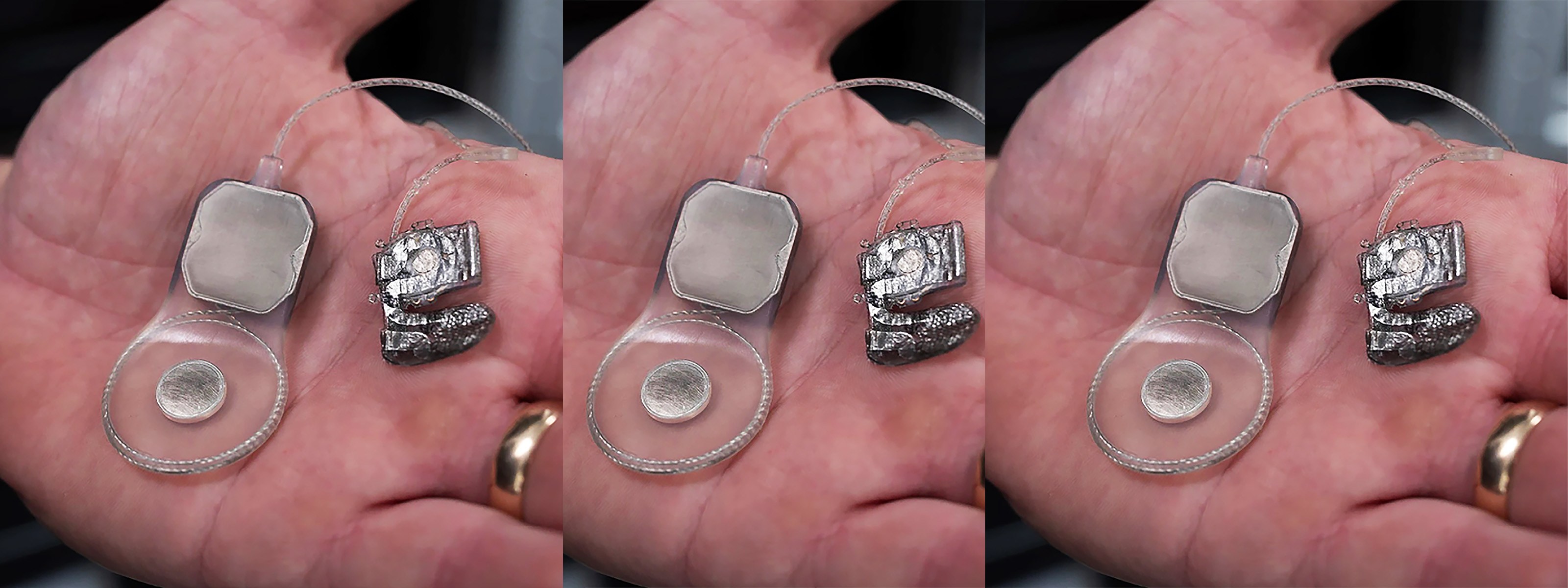 Experimental bionic eye is ready for human trials