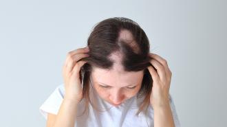 alopecia treatment