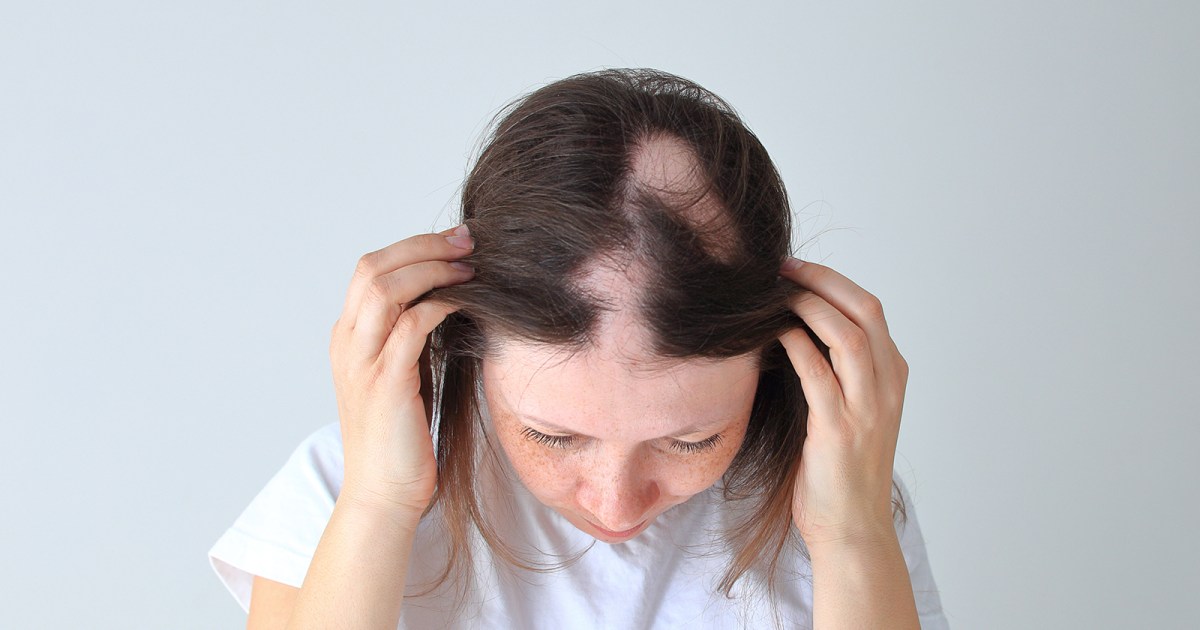 A common arthritis drug treats alopecia (Updated)