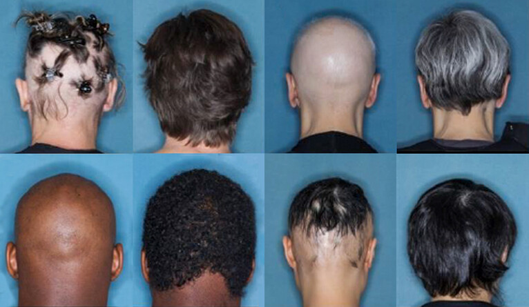 alopecia treatment