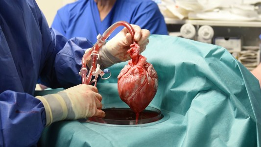 pig heart transplant