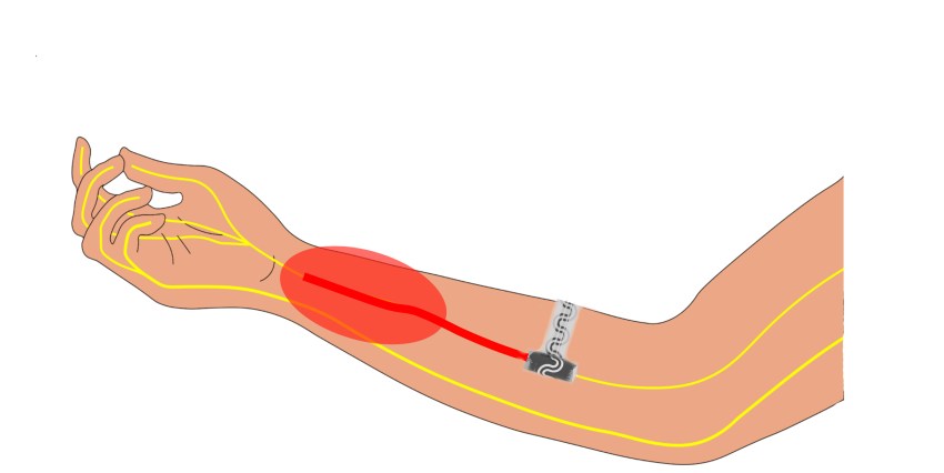 Targeted Pain Relief Illustration