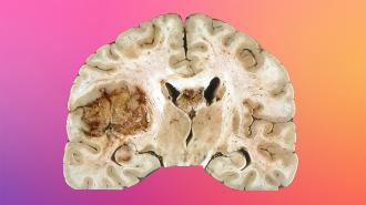 glioblastoma tumors