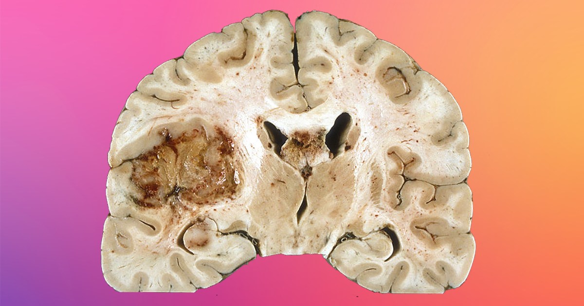 New treatment “starves” aggressive brain tumors in mice