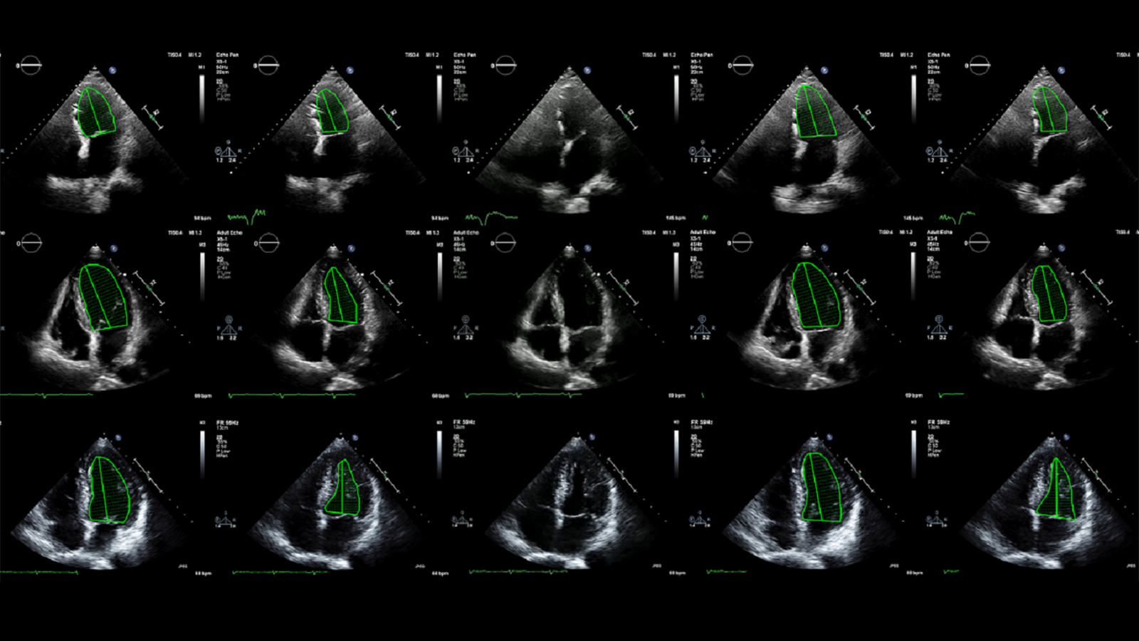 First-of-its-kind trial shows AI beat humans at analyzing heart scans