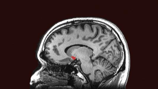 binge eating disorder