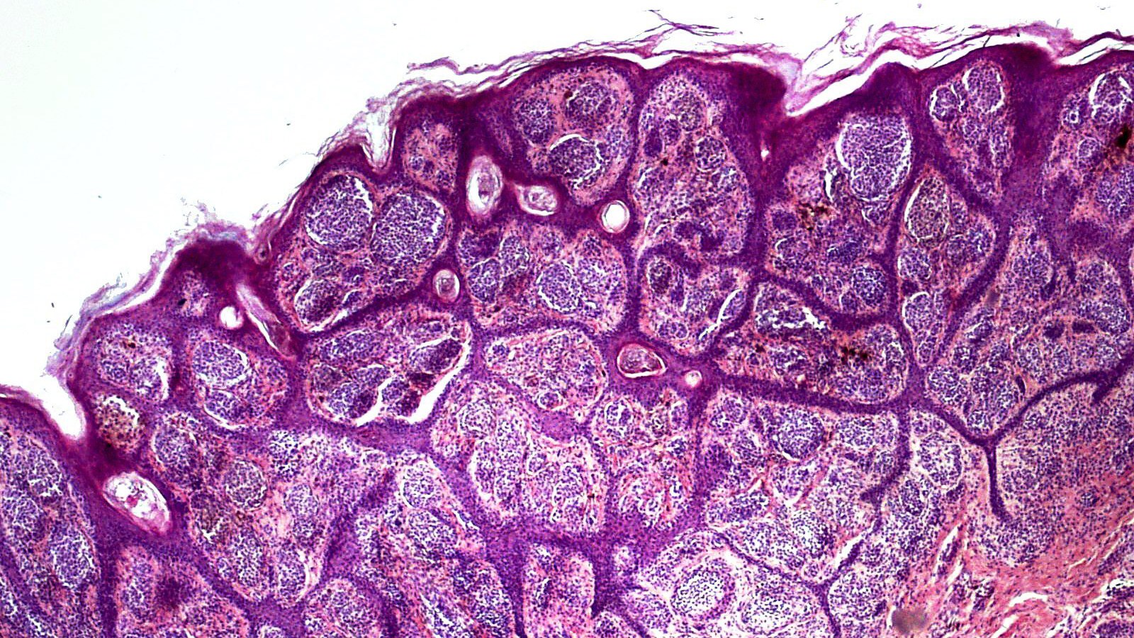 AI could help cancer patients avoid a deadly melanoma recurrence