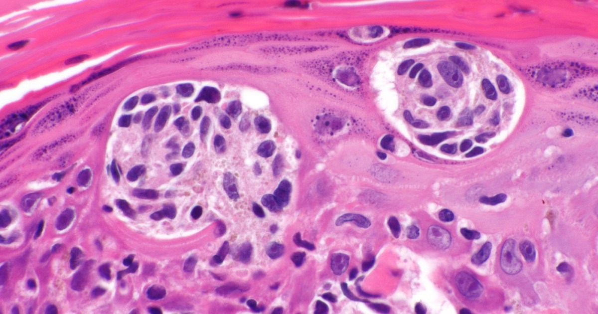 Moderna's mRNA cancer vaccine reduces risk of recurrence or death by 44%