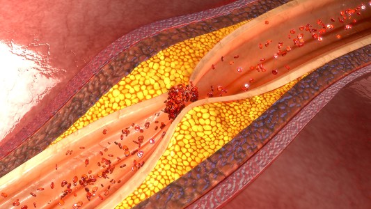cholesterol build up in an artery