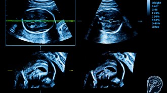 fetal ultrasounds