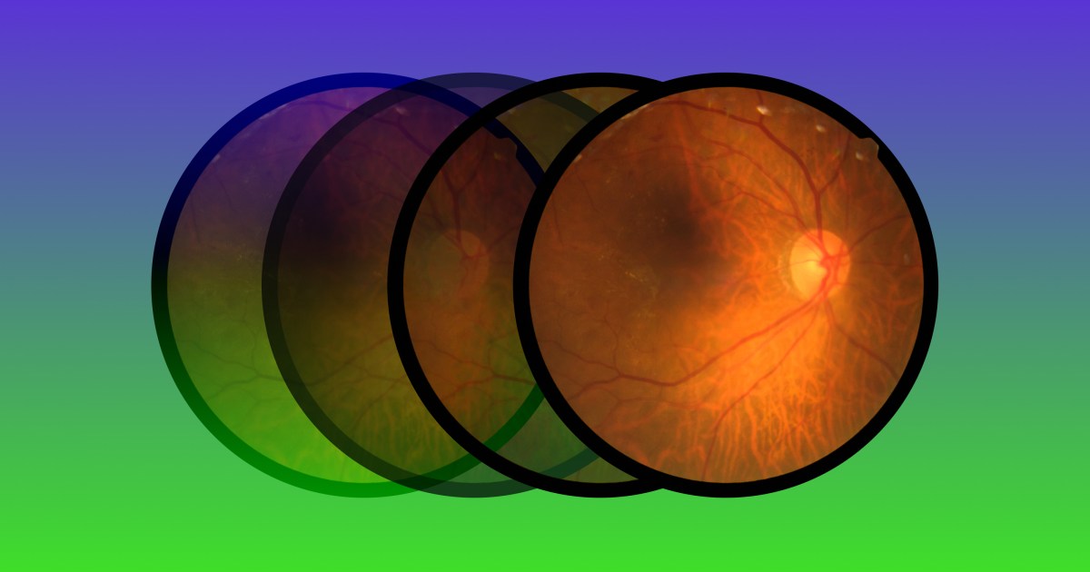 La nuova terapia genica potrebbe invertire la degenerazione retinica