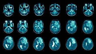 MRI scans of glioblstomas