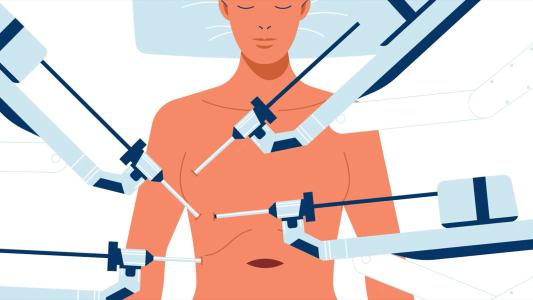 an illustration of a patient receiving a lung transplant by four robotic arms