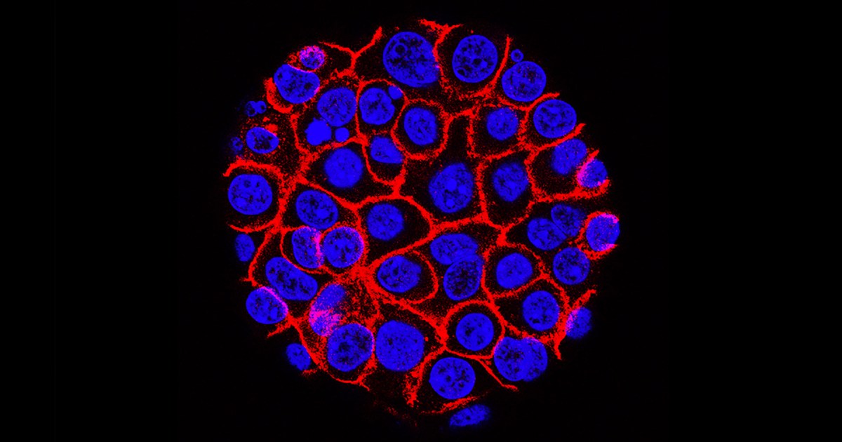 New AI predicts who is most at risk of pancreatic cancer