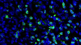 An image of blue tumor cells and green immune cells