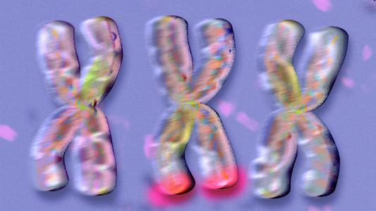 Three fragile x syndrome dna strands on a purple background.