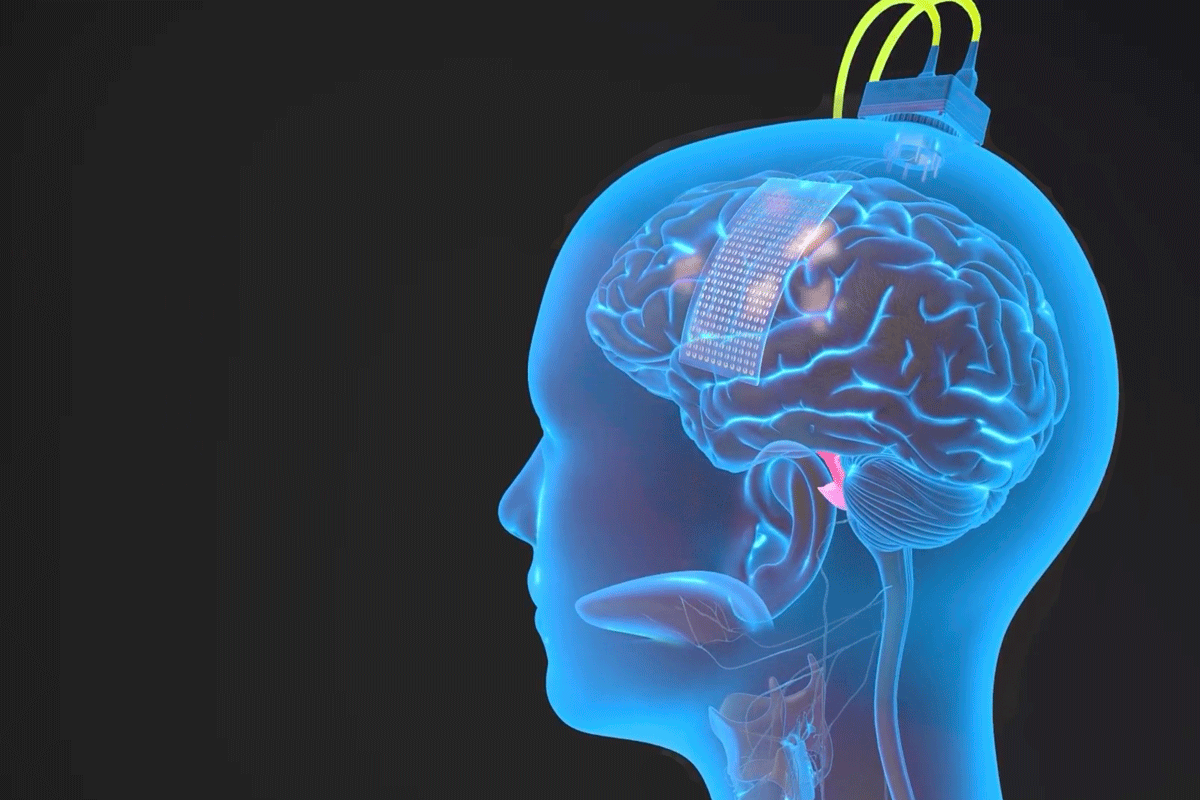 A person's brain is shown with a speech BCI device attached to it.