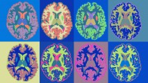 a grid of colorful scans of the brain of a person with MS