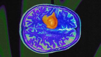 An MRI image of a brain with gliomas.