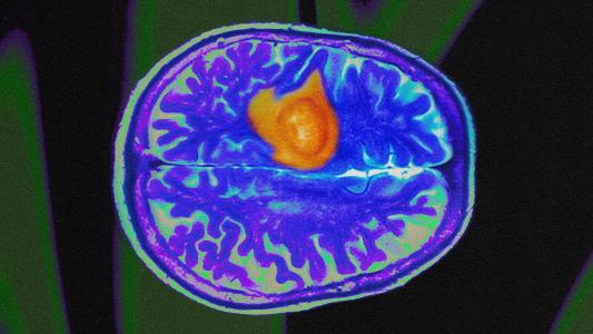 An MRI image of a brain with gliomas.