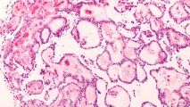 glioma cells under a microscope