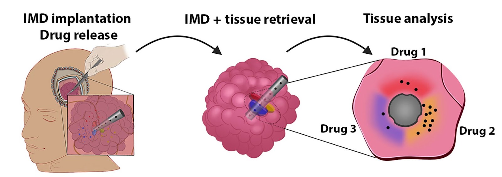 A diagram illustrating how the microdevice is used, from insertion in the brain, to tumor removal, to tumor analysis