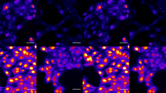 a grid of eight images of cancer cells being treated with lidocaine