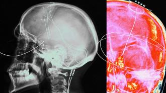 A collage featuring images of an x-ray of deep brain stimulation