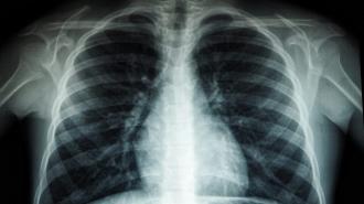 An x - ray of a person's chest.