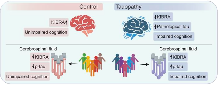A diagram showing the differences in tau, KIBRA, and cognitive decline in people with and without Alzheimer's disease