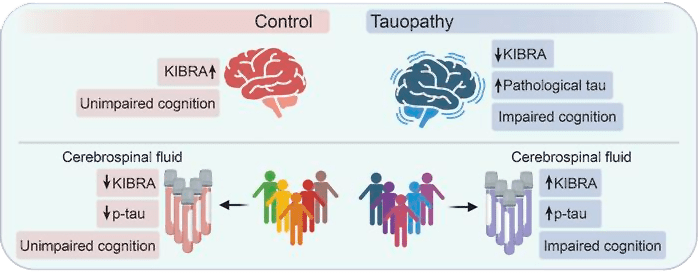 A diagram showing the differences in tau, KIBRA, and cognitive decline in people with and without Alzheimer's disease